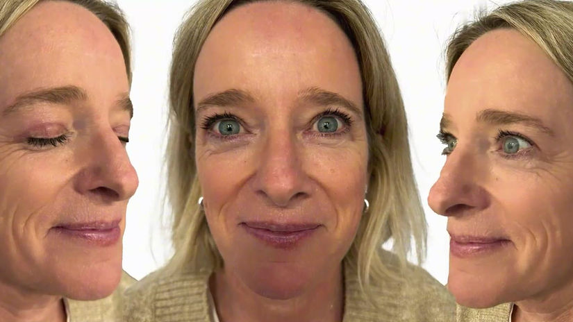 Blefaroplastia Superior Horizontal